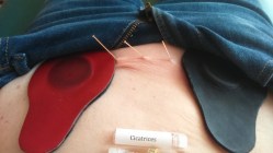 Regulación de cicatriz por cesárea.