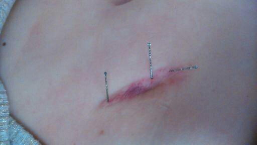 Cicatriz por apendicitis.