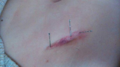 Regulación energética de cicatriz por apendicitis.